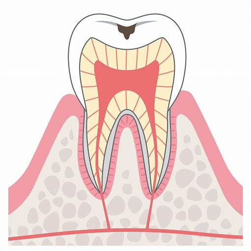 C1（エナメル質の虫歯）