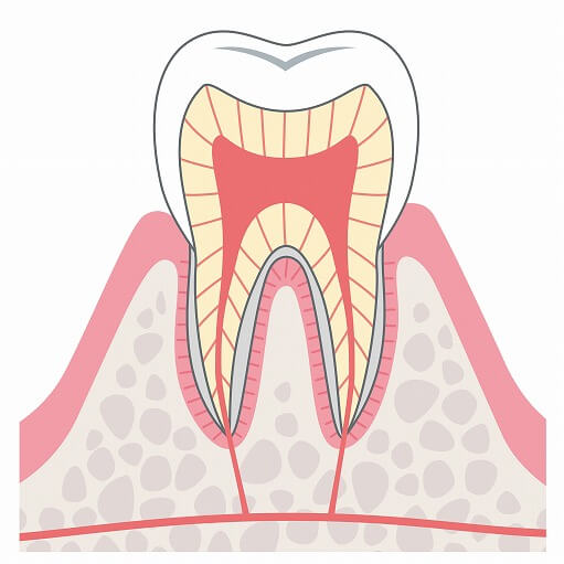 CO（（Questionable Caries for Observation：初期虫歯）