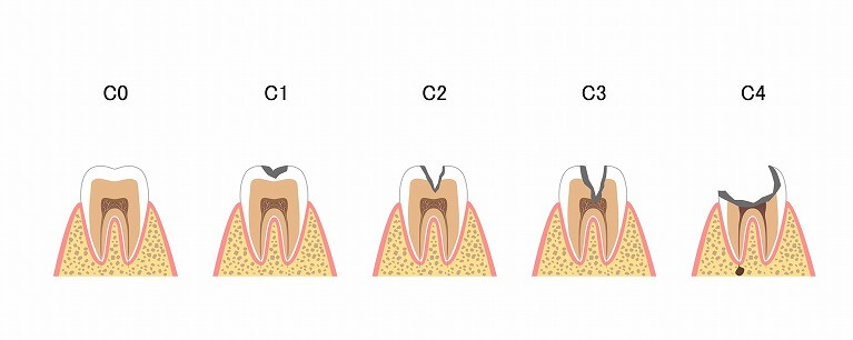 虫歯を放置すると起こるトラブル