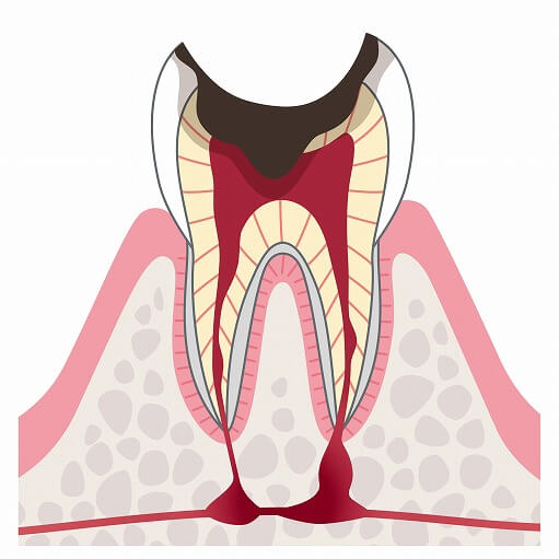 C4（歯根だけが残った虫歯）