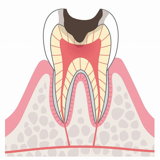 C3（歯髄まで達した虫歯）