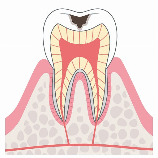 C2（象牙質まで達した虫歯）