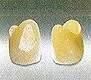 硬質レジンジャケット冠