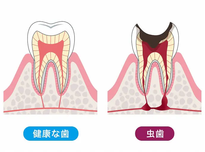 神経が死ぬと歯の寿命が短くなる