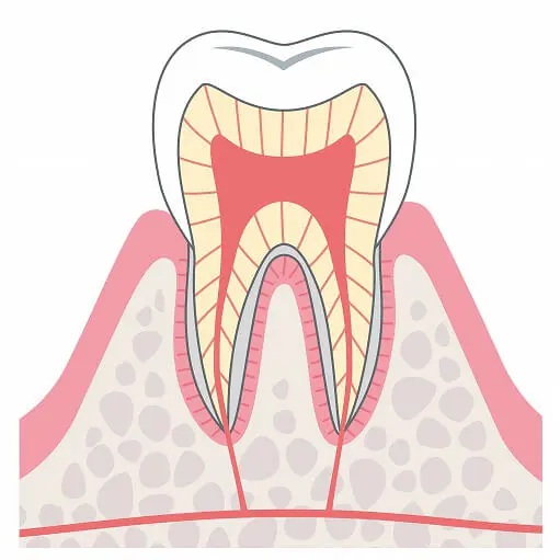 CO（（Questionable Caries for Observation：初期虫歯）