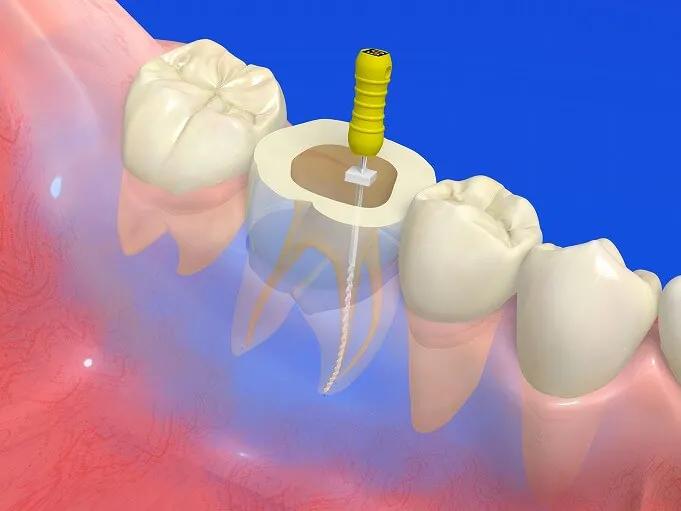 根管治療とは？