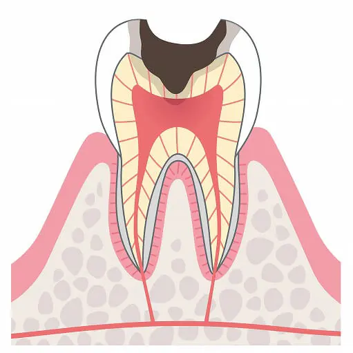 C3（歯髄まで達した虫歯）
