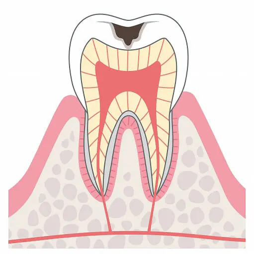 C2（象牙質まで達した虫歯）