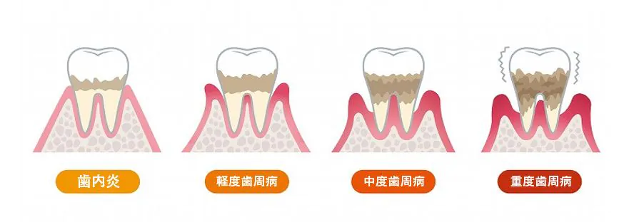 歯周病とは