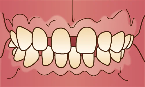 正中離開、空隙歯列(すきっ歯)