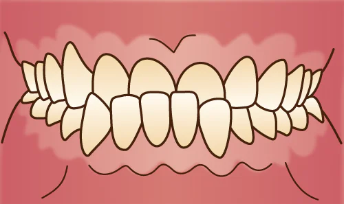 反対咬合(受け口)